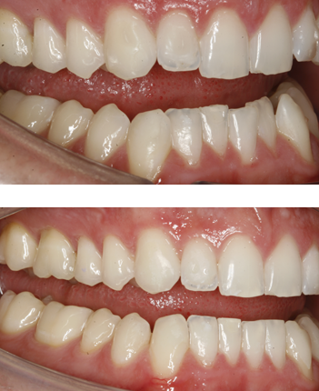 Before & after Invisalign near me